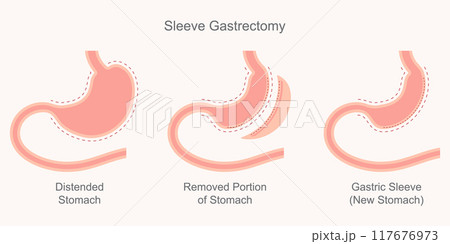 Sleeve gastrectomy, part of the stomach. Sleeve gastrectomy, part of the stomach. 117676973