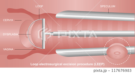 A LEEP (loop electrosurgical excision procedure). 117676983