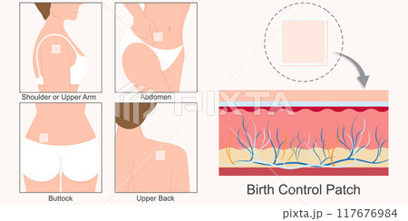 Birth Control Patch is square patch that sticks to the skin. Birth Control Patch is square patch that sticks to the skin. 117676984