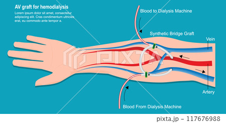 An arteriovenous (AV) graft is a type of access used for hemodialysis. An arteriovenous (AV) graft is a type of access used for hemodialysis. 117676988