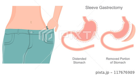 Bariatric surgery is done to help lose extra weight. 117676989