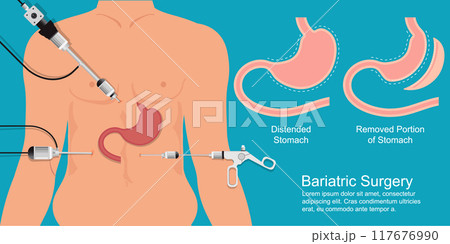Bariatric surgery is done when diet and exercise. Bariatric surgery is done when diet and exercise. 117676990