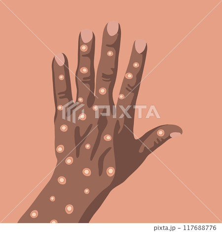 Vector isolated illustration of a hand of a black man with monkey pox. Vector isolated illustration of a hand of a black man with monkey pox. 117688776