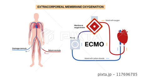 Extracorporeal membrane oxygenation 117696785