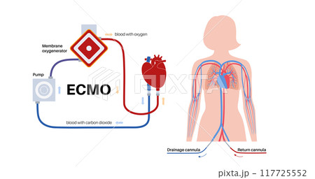 Extracorporeal membrane oxygenation Extracorporeal membrane oxygenation 117725552