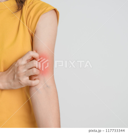 woman itching and scratching itchy arm. Sensitive Skin Allergic reaction to insect bite, food, drug dermatitis. Dermatology, Leprosy day, Systemic lupus erythematosus, Allergy symptoms and rash Eczema woman itching and scratching itchy arm. Sensitive Skin Allergic reaction to insect bite, food, drug dermatitis. Dermatology, Leprosy day, Systemic lupus erythematosus, Allergy symptoms and rash Eczema 117733344