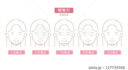 顎整形の手術法のイラスト 117734568