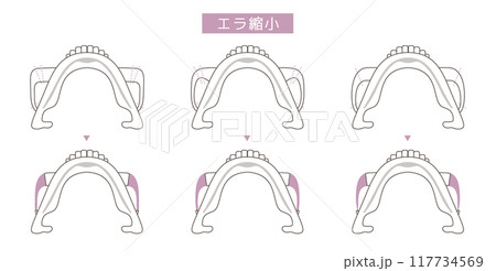 エラ縮小手術の方法イラスト 117734569