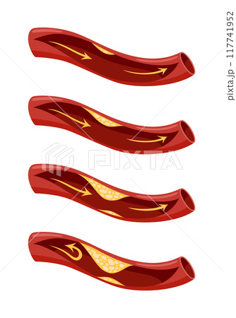 Atherosclerosis stage icon set. Anatomy of heart attack. Arteriosclerotic vascular disease or ASVD. Atherosclerotic plaque in coronary artery. Vector illustration on white background 117741952