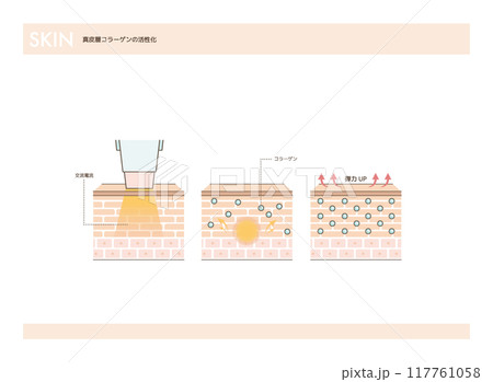 真皮層コラーゲンを活性化する高周波治療のイラスト 117761058