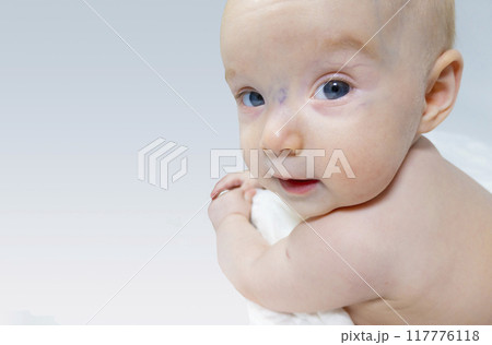a baby with a hemangioma on his neck lies on a white background a baby with a hemangioma on his neck lies on a white background 117776118