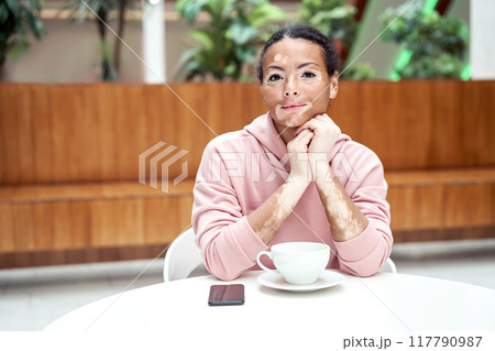 Black african american woman with vitiligo Black african american woman with vitiligo 117790987