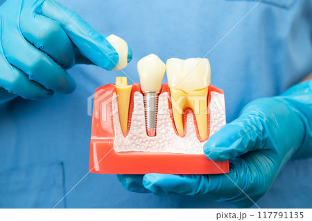 Asian dentist holding dental implant, artificial tooth roots into jaw, root canal of dental treatment, gum disease, teeth model for dentist. Asian dentist holding dental implant, artificial tooth roots into jaw, root canal of dental treatment, gum disease, teeth model for dentist. 117791135