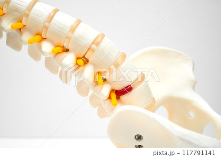 Lumbar spine displaced herniated disc fragment, spinal nerve and bone. Model for treatment medical in the orthopedic department. Lumbar spine displaced herniated disc fragment, spinal nerve and bone. Model for treatment medical in the orthopedic department. 117791141