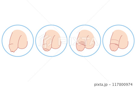 男性生殖器　包茎　種類　医療 117800974