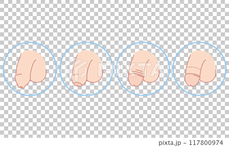 男性生殖器　包茎　種類　医療 117800974