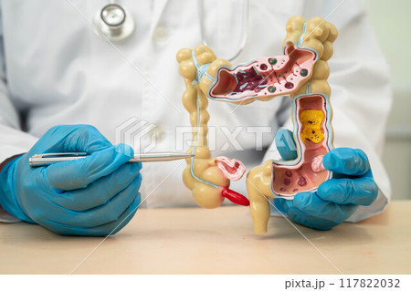 Ulcerative Colitis. Intestine, appendix and digestive system, doctor holding anatomy model for study diagnosis and treatment in hospital. Ulcerative Colitis. Intestine, appendix and digestive system, doctor holding anatomy model for study diagnosis and treatment in hospital. 117822032