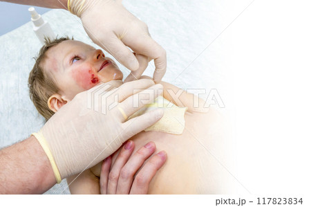 dressing a boy with a burn from boiling water 117823834