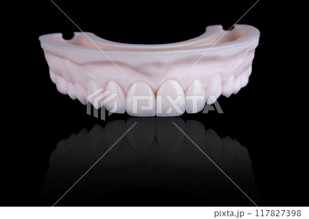 Four dental ultra-thin ceramic veneers in bleach color for fixation to frontal teeth of upper jaw. Four dental ultra-thin ceramic veneers in bleach color for fixation to frontal teeth of upper jaw. 117827398