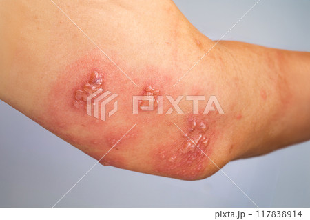 Shingles, Zoster or Herpes Zoster symptoms on arm. Shingles, Zoster or Herpes Zoster symptoms on arm. 117838914