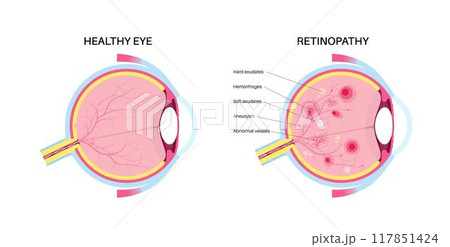 Diabetes related retinopathy 117851424