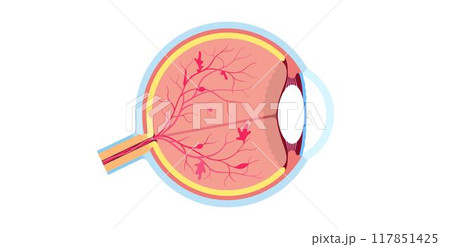 Diabetes related retinopathy 117851425