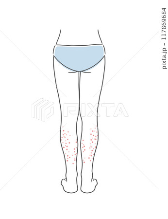 膝下が肌荒れしている女性の下半身のイラスト素材 膝下が肌荒れしている女性の下半身のイラスト素材 117869684