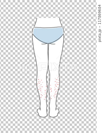 膝下が肌荒れしている女性の下半身のイラスト素材 膝下が肌荒れしている女性の下半身のイラスト素材 117869684