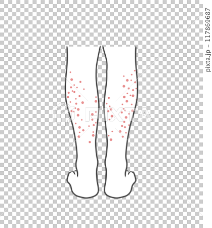 肌荒れ(ブツブツ)している女性のふくらはぎのイラスト素材 肌荒れ(ブツブツ)している女性のふくらはぎのイラスト素材 117869687