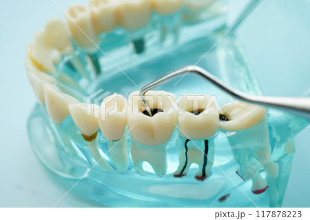 Teeth dental model with tool for dentist use to cleaning care treatment. Teeth dental model with tool for dentist use to cleaning care treatment. 117878223
