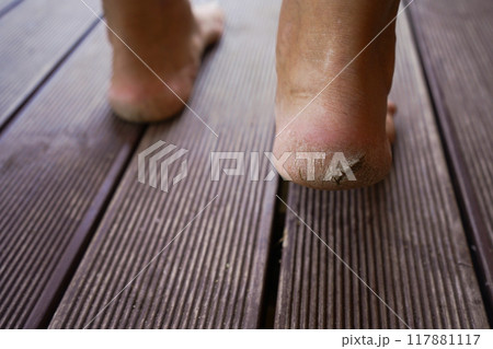 Close-up of cracked heels, skin diseases. Close-up of cracked heels, skin diseases. 117881117