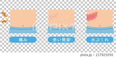 帯状疱疹の症状　医療 117925050