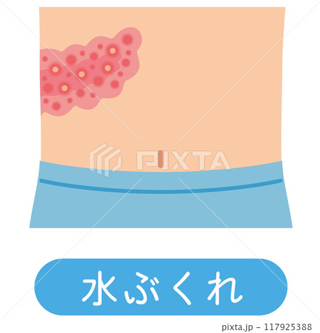 帯状疱疹の症状 医療 帯状疱疹の症状 医療 117925388