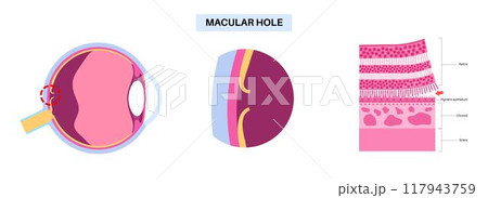 Macular hole disease Macular hole disease 117943759