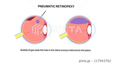 Pneumatic retinopexy poster Pneumatic retinopexy poster 117943762