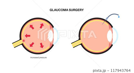 Glaucoma surgery poster Glaucoma surgery poster 117943764