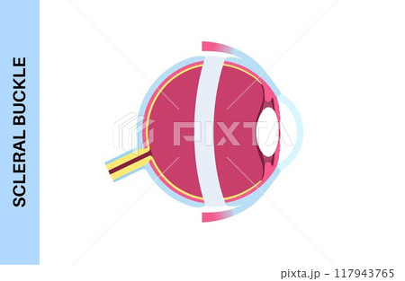 Scleral buckle procedure 117943765