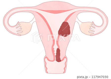 子宮頸がんと子宮体がんの違い わかりやすい図解イラスト 117947030