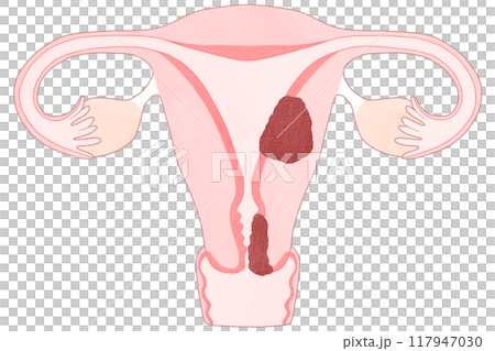子宮頸がんと子宮体がんの違い わかりやすい図解イラスト 117947030