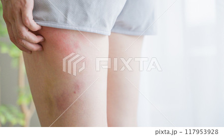 太ももの湿疹を掻きむしる女性 117953928