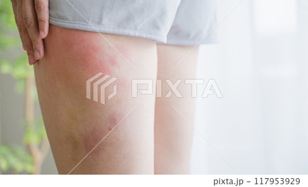 太ももの湿疹を掻きむしる女性 117953929