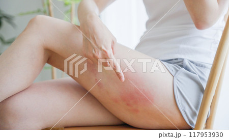 太ももの湿疹を掻きむしる女性 太ももの湿疹を掻きむしる女性 117953930