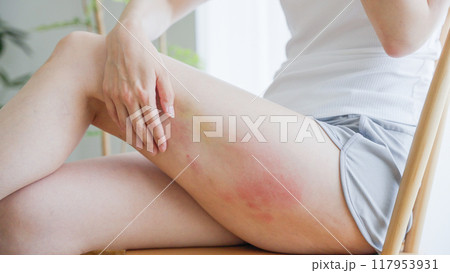 太ももの湿疹を掻きむしる女性 117953931