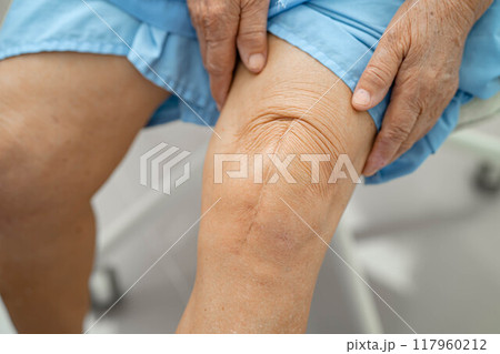 Asian elderly woman patient show her scars surgical total knee joint replacement Suture wound surgery arthroplasty. Asian elderly woman patient show her scars surgical total knee joint replacement Suture wound surgery arthroplasty. 117960212