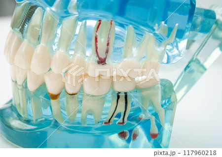 Artificial tooth roots dental implant into jaw, Root canal model for dentist. Artificial tooth roots dental implant into jaw, Root canal model for dentist. 117960218