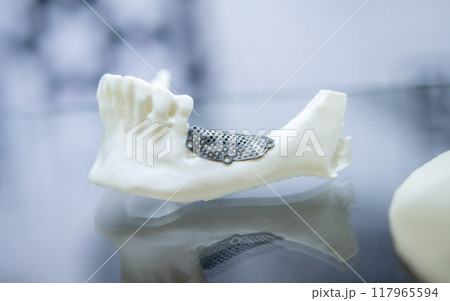 Prototype of lower human jaw with medical titanium implant from biocompatible titanium printed on 3D printer. Maxillo-facial prosthesis anatomical human bone from metal powder. Medicine medical Prototype of lower human jaw with medical titanium implant from biocompatible titanium printed on 3D printer. Maxillo-facial prosthesis anatomical human bone from metal powder. Medicine medical 117965594
