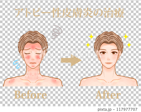 成年男性接受異位性皮膚炎治療前後的插圖素材 成年男性接受異位性皮膚炎治療前後的插圖素材 117977707