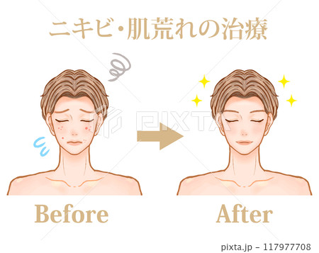 美容皮膚科でニキビ治療した大人男性のビフォーアフターのイラスト素材 117977708