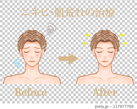 一名成年男子在美容皮膚科醫生處接受痤瘡治療前後的插圖材料 一名成年男子在美容皮膚科醫生處接受痤瘡治療前後的插圖材料 117977708
