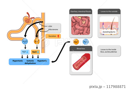 hypertonic, isotonic, and hypotonic dehydration, their causes, and the hormonal influence on water and salt loss. 2d graphic 117988871